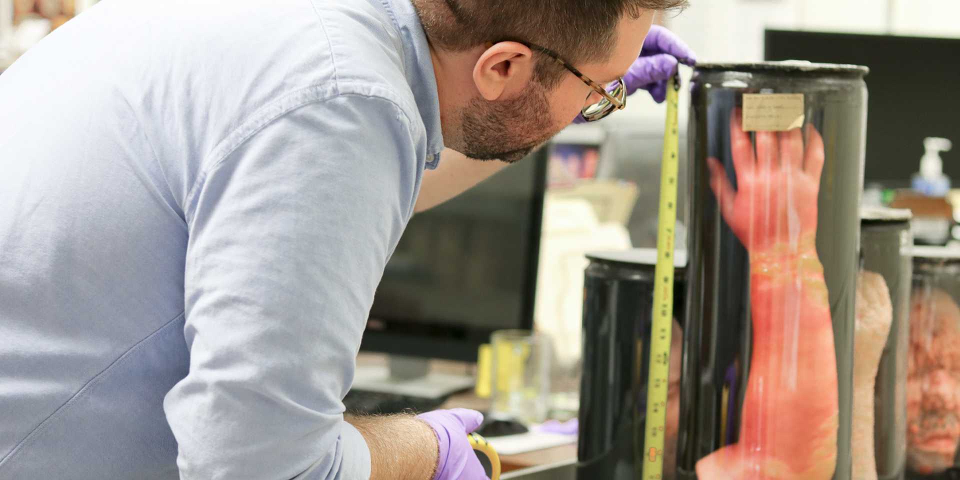 Man wearing purple gloves measuring a model of an arm with skin disease